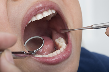 乳歯の虫歯の特徴