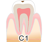 虫歯の進行について