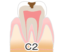 虫歯の進行について