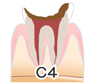 虫歯の進行について