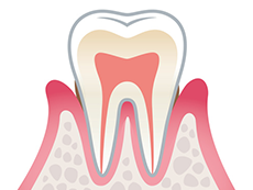歯周病の進行について