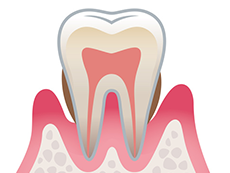 歯周病の進行について