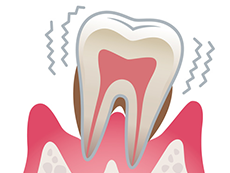 歯周病の進行について